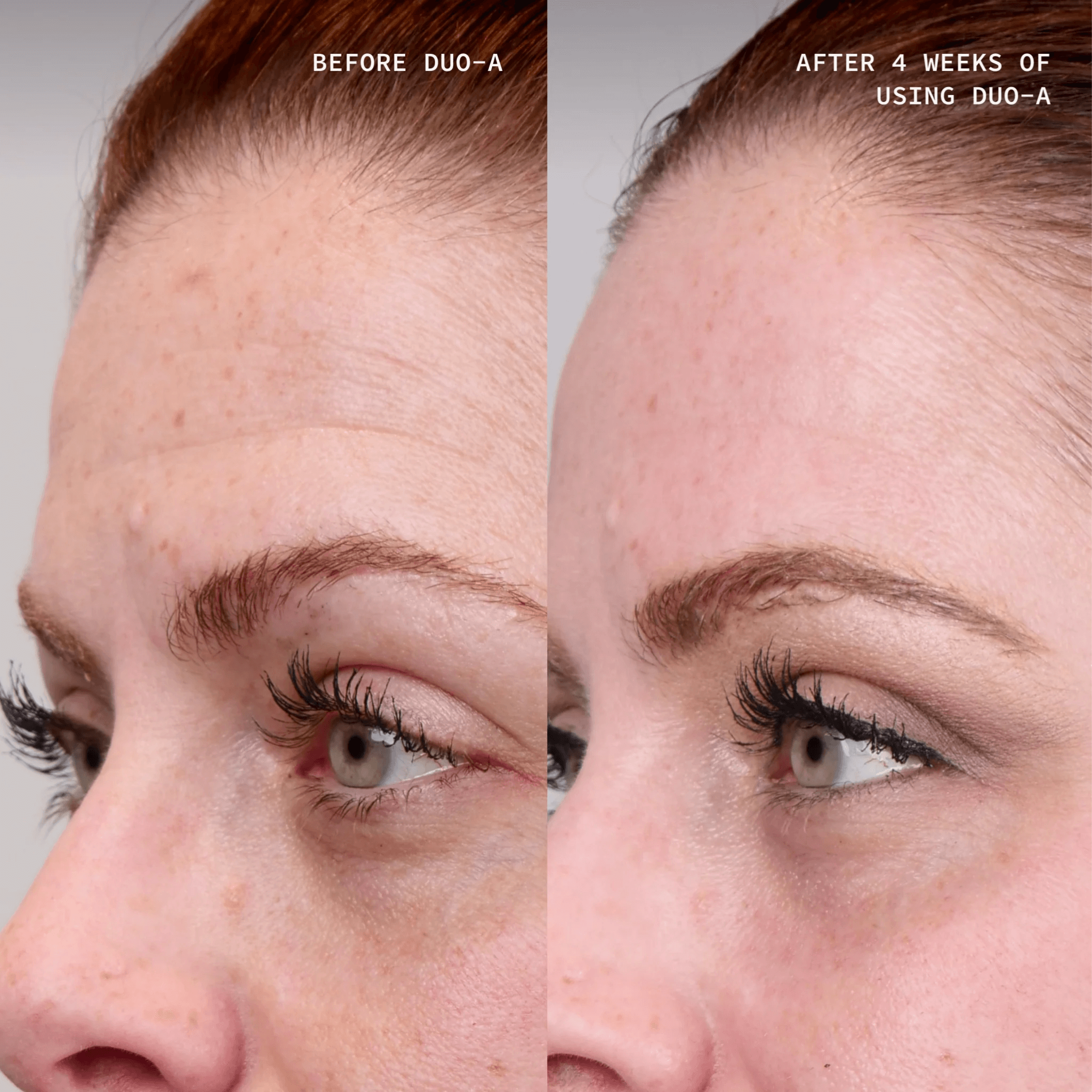 Before and after comparison of a woman's face showing skin improvement with 'Cosmedix Elite DUO-A'.