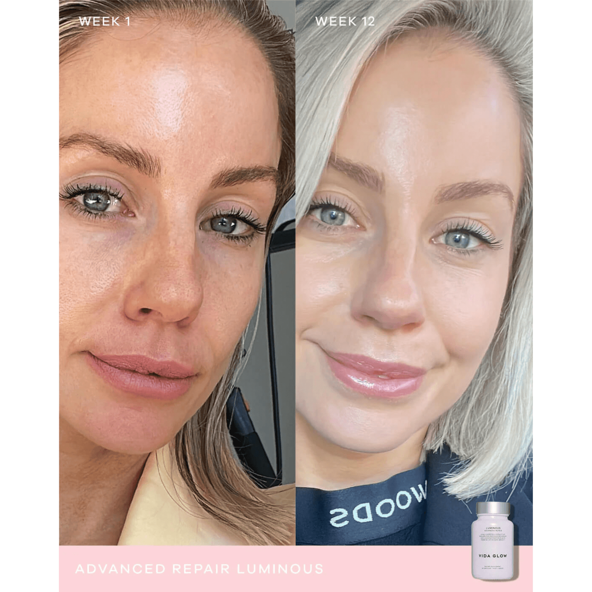 Before and after comparison of a woman's face with a product labeled 'Vida Glow Luminous' on a white background