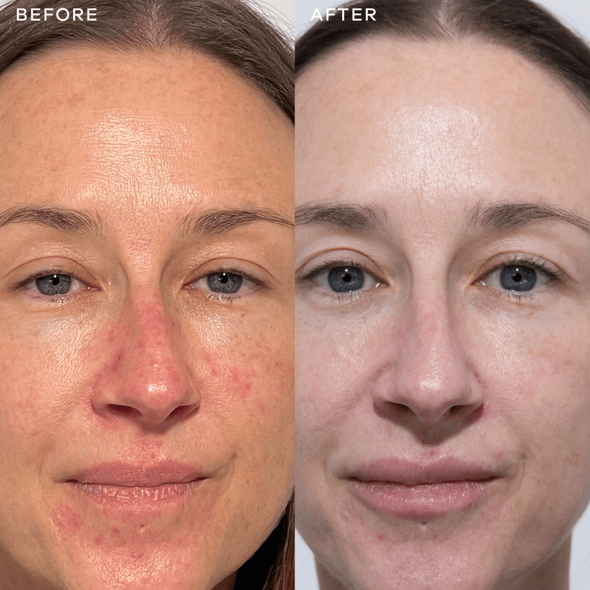 Before and after comparison of a woman's face with visible skin improvement from taking Vida Glow Radiance Plus