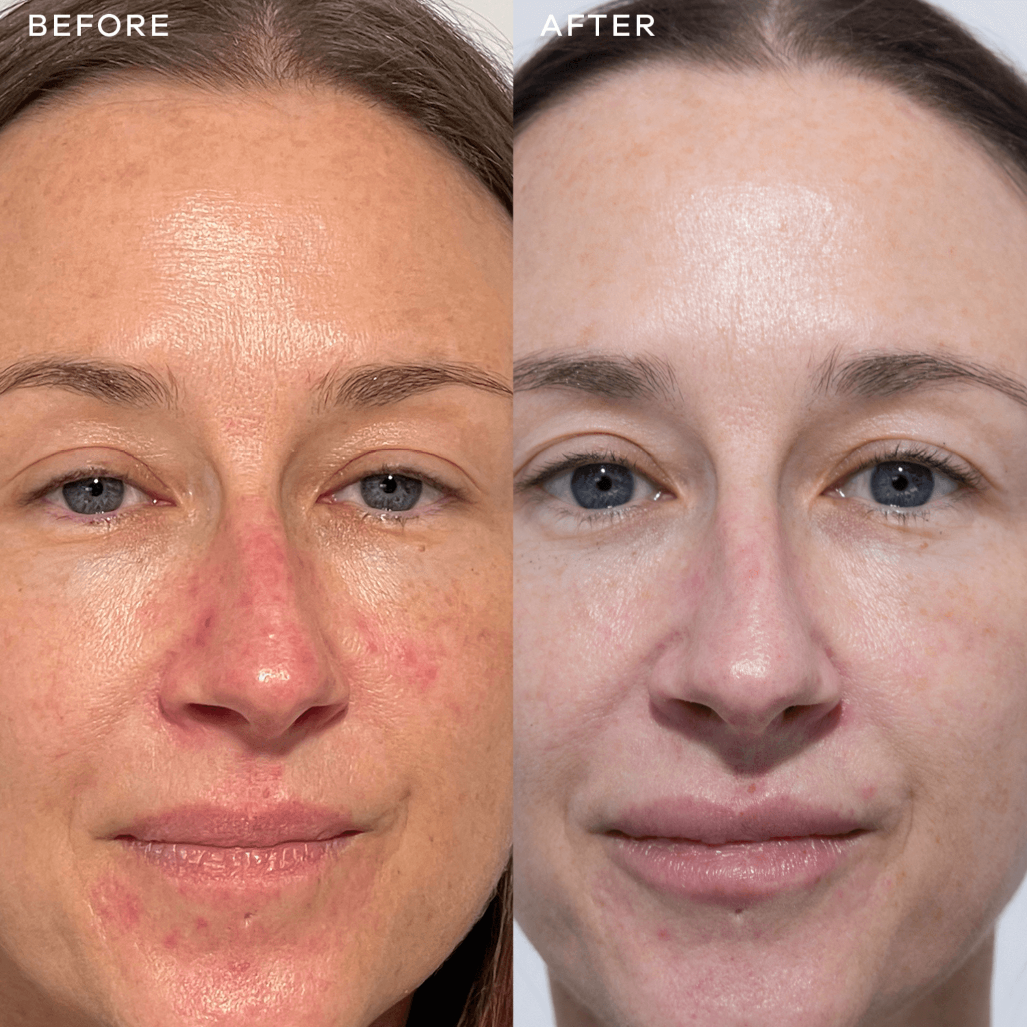 Before and after comparison of a woman's face with visible skin improvement from taking Vida Glow Radiance Plus