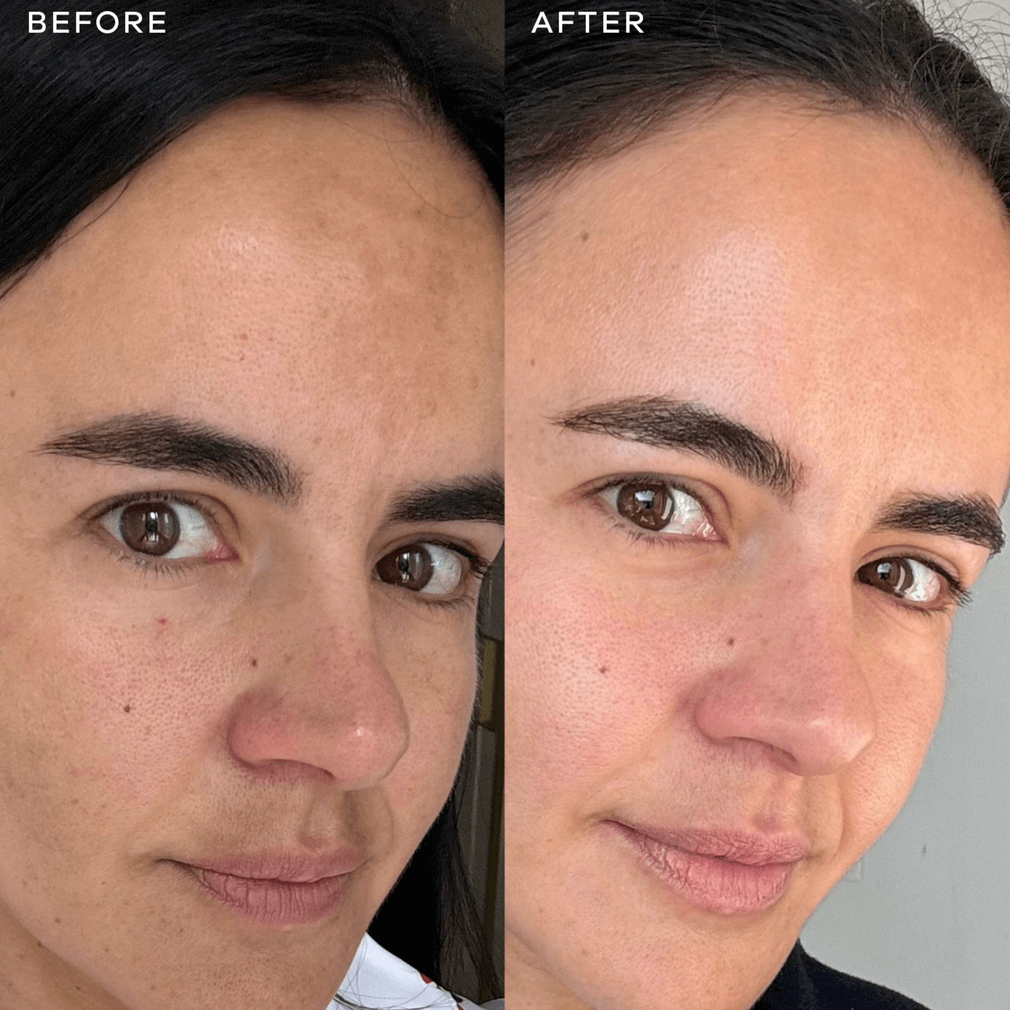 Before and after comparison of a person's face with visible skin improvement from Vida Glow Radiance Plus capsules