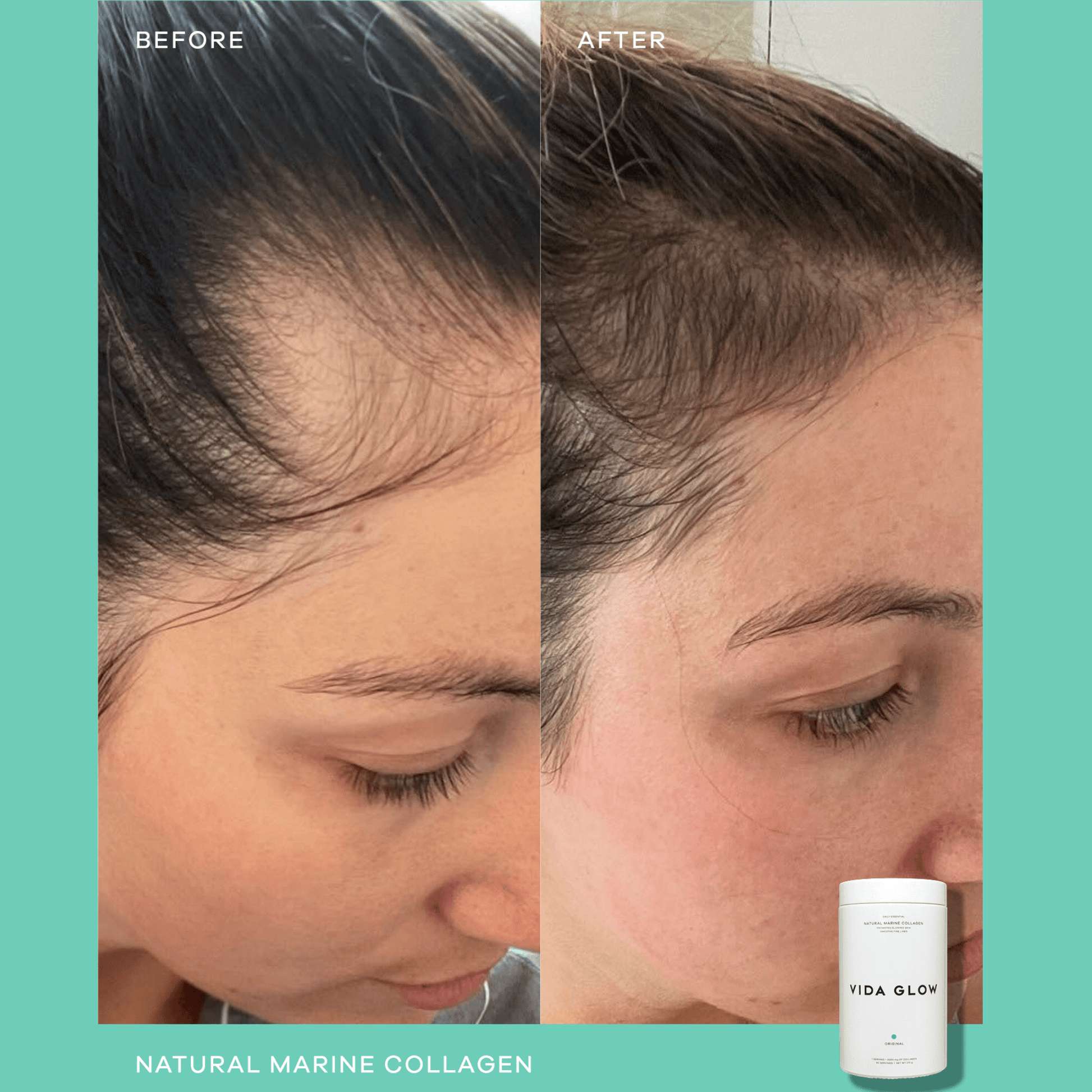 Before and after comparison of a woman's hair growth with Vida Glow natural marine collagen product.