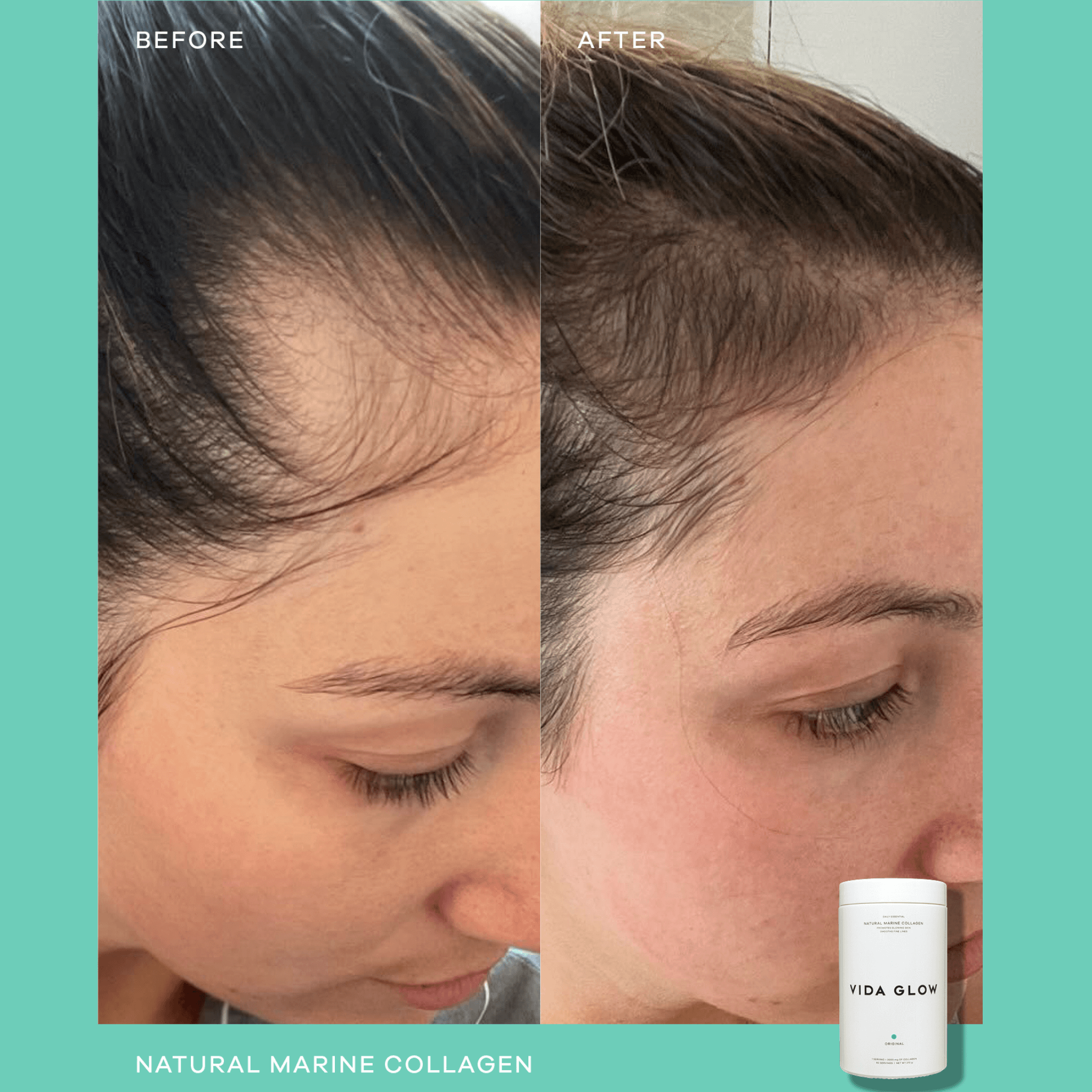 Before and after comparison of a woman's hair growth with Vida Glow natural marine collagen product.