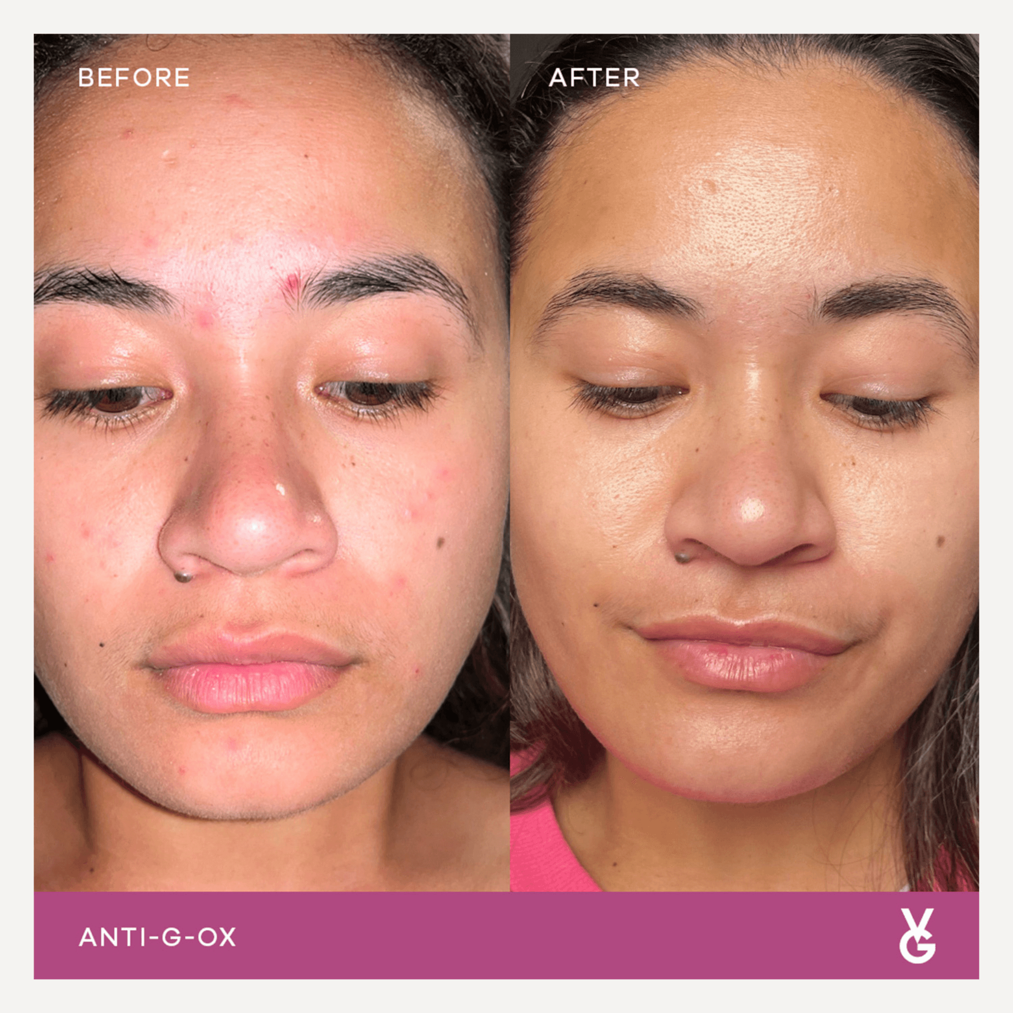 VidaGlow anti-g-ox-before and after result